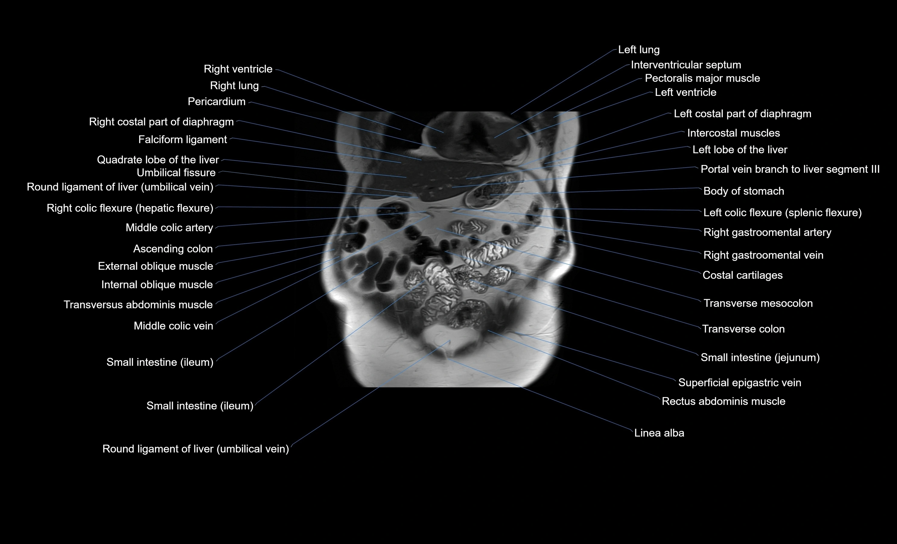 MRI Abdomen coronal labelled cross sectional anatomy radiology  image-img-00001-00014.webp